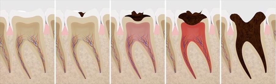 むし歯の段階と治療方法
