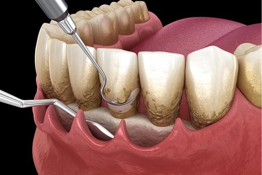 歯周病の治療法