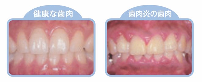 妊娠中に起こりやすいお口の中の変化